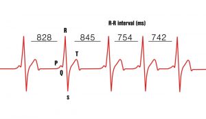 átlagos percenkénti szívverés hypertension symptoms headache